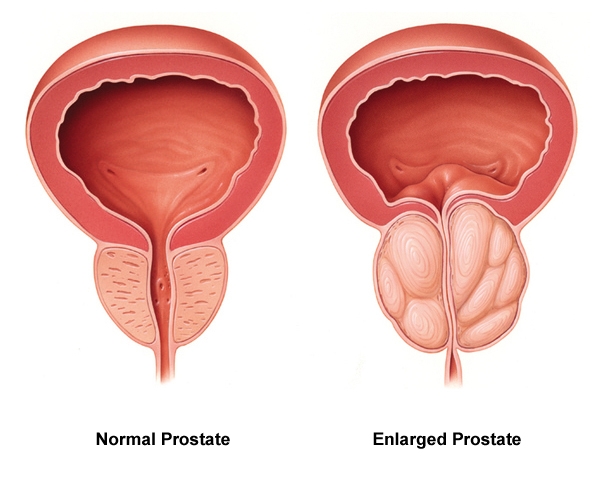 prostate quercetine